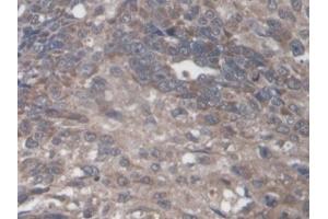 Detection of PTPRF in Human Lung cancer Tissue using Polyclonal Antibody to Protein Tyrosine Phosphatase Receptor Type F (PTPRF)