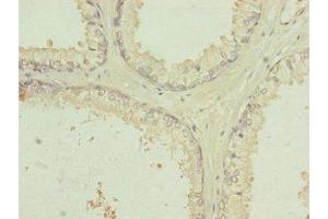 Immunohistochemistry of paraffin-embedded human prostate cancer using ABIN7151092 at dilution of 1:100 (RNF41 anticorps  (AA 1-317))