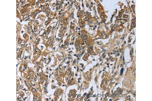 Immunohistochemistry of Human gastic cancer using PRL Polyclonal Antibody at dilution of 1:50 (Prolactin anticorps)