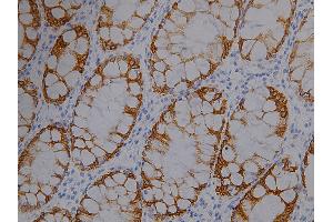 IHC analysis (400X) of CK19 expression in colon cancer, using CK19 antibody (1:1000 dilution). (Cytokeratin 19 anticorps  (full length))