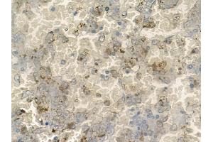 ABIN6260113 and ABIN6272523 at 1/100 staining human melanoma by IHC-P. (ATOH8 anticorps  (C-Term))