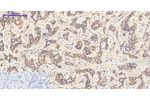 Immunohistochemistry of paraffin-embedded Human liver cancer tissue with Phospho-JAK1 (Tyr1022) Polyclonal Antibody at dilution of 1:200 (JAK1 anticorps  (pTyr1022))