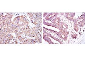 Immunohistochemical analysis of paraffin-embedded liver cancer tissues (left) and stomach cancer tissues (right) using RBP4 mouse mAb with DAB staining. (RBP4 anticorps)