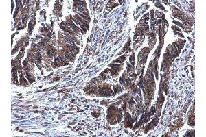 IHC-P Image SDHB antibody [C2C3], C-term detects SDHB protein at mitochindria on human colon carcinoma by immunohistochemical analysis.