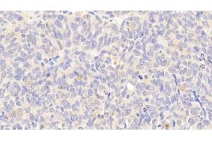 Detection of HSPA8 in Human Ovarian cancer Tissue using Polyclonal Antibody to Heat Shock 70 kDa Protein 8 (HSPA8)