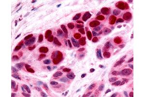 Anti-Nor-1 / NR4A3 antibody IHC of human Skin, Melanoma.