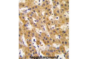 Formalin-fixed and paraffin-embedded human hepatocarcinomareacted with PDHX polyclonal antibody , which was peroxidase-conjugated to the secondary antibody, followed by AEC staining. (PDHX anticorps  (Thr11))