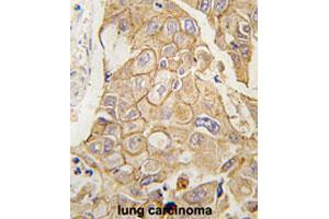 Formalin-fixed and paraffin-embedded human lung carcinomareacted with ADCY2 polyclonal antibody , which was peroxidase-conjugated to the secondary antibody, followed by AEC staining. (ADCY2 anticorps  (C-Term))