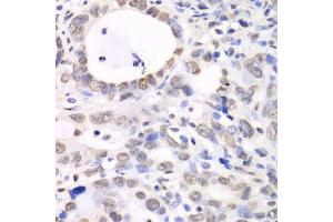 Immunohistochemistry of paraffin-embedded human gastric cancer using Nono Antibody. (NONO anticorps  (AA 1-300))