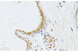 Immunohistochemistry of paraffin-embedded Human breast cancer using ANKRD52 Polyclonal Antibody at dilution of 1:100 (40x lens). (ANKRD52 anticorps)