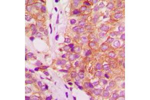 Immunohistochemical analysis of Filamin A staining in human breast cancer formalin fixed paraffin embedded tissue section. (Filamin A anticorps  (C-Term))
