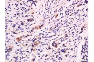 Formalin-fixed and paraffin embedded human colon cancer labeled with Anti-CD53 Polyclonal Antibody, Unconjugated  at 1:200 followed by conjugation to the secondary antibody and DAB staining. (CD53 anticorps  (AA 65-160))