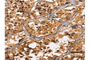 The image on the left is immunohistochemistry of paraffin-embedded Human thyroid cancer tissue using ABIN7190461(DEFA5 Antibody) at dilution 1/15, on the right is treated with synthetic peptide. (DEFA5 anticorps)
