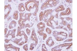IHC-P Image Immunohistochemical analysis of paraffin-embedded human breast cancer, using DDR2, antibody at 1:250 dilution.
