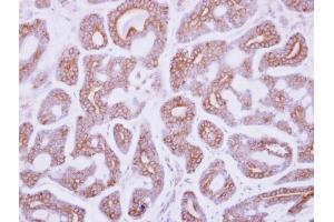 IHC-P Image Immunohistochemical analysis of paraffin-embedded human breast cancer, using DDR2, antibody at 1:250 dilution. (DDR2 anticorps  (C-Term))