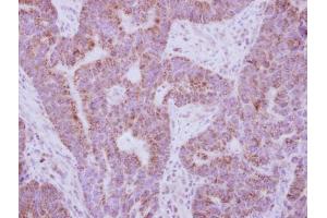 IHC-P Image Immunohistochemical analysis of paraffin-embedded human colon carcinoma, using IL10 Receptor alpha, antibody at 1:250 dilution. (IL-10RA anticorps)