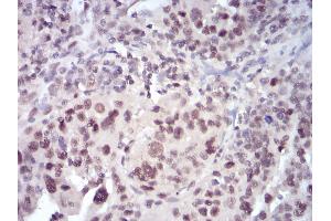 Immunohistochemical analysis of paraffin-embedded human ovarian cancer tissues using SELL mouse mAb with DAB staining. (L-Selectin anticorps  (AA 83-186))