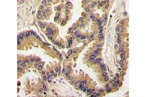 IHC analysis of FFPE human lung carcinoma tissue stained with BMP6 antibody (BMP6 anticorps  (AA 25-55))