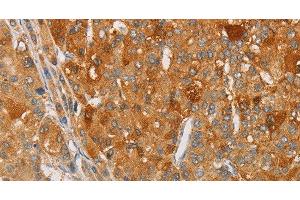 Immunohistochemistry of paraffin-embedded Human liver cancer tissue using ARSG Polyclonal Antibody at dilution 1:30 (ARSG anticorps)