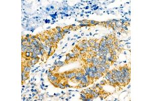 Immunohistochemistry of paraffin embedded human colon cancer using Notch4 (ABIN7074863) at dilution of 1:600 (400x lens) (NOTCH4 anticorps)