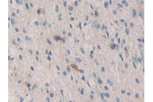 Detection of BMP15 in Human Glioma Tissue using Polyclonal Antibody to Bone Morphogenetic Protein 15 (BMP15)