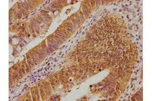 IHC image of ABIN7139932 diluted at 1:100 and staining in paraffin-embedded human colon cancer performed on a Leica BondTM system.