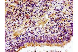 Immunohistochemistry of paraffin-embedded human lung cancer using ABIN7147616 at dilution of 1:100 (Choline Kinase alpha anticorps  (AA 79-173))