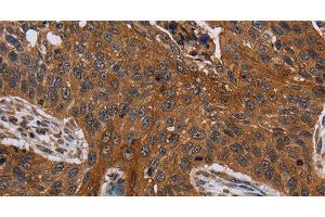 Immunohistochemistry of paraffin-embedded Human lung cancer using Catenin gamma Polyclonal Antibody at dilution of 1:40 (JUP anticorps)