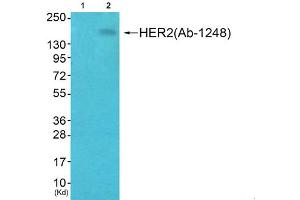 Immunohistochemical analysis of paraffin-embedded human breast carcinoma tissue, using HER2 (phospho-Tyr1248) antibody. (ErbB2/Her2 anticorps  (pTyr1248))