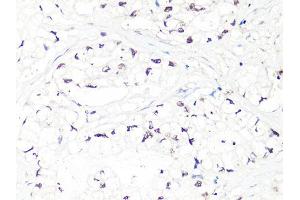 Immunohistochemistry of paraffin-embedded human gastric cancer using MTA2 Antibody (ABIN5998268) at dilution of 1/100 (40x lens). (MTA2 anticorps)