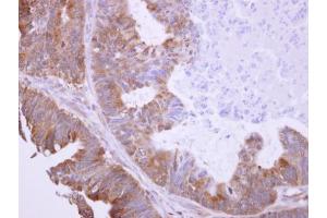 IHC-P Image BHMT antibody detects BHMT protein at cytosol on human colon carcinoma by immunohistochemical analysis. (BHMT anticorps)