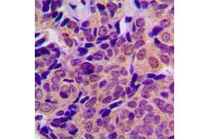 Immunohistochemical analysis of Beta Amyloid (pT743) staining in human breast cancer formalin fixed paraffin embedded tissue section.
