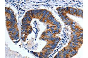 The image on the left is immunohistochemistry of paraffin-embedded Human colon cancer tissue using ABIN7128939(CHRM2 Antibody) at dilution 1/3, on the right is treated with fusion protein. (Muscarinic Acetylcholine Receptor M2 anticorps)