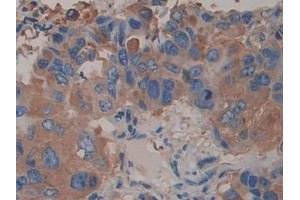 Detection of ACTN4 in Human Breast cancer Tissue using Polyclonal Antibody to Actinin Alpha 4 (ACTN4)