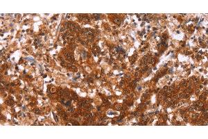 Immunohistochemistry of paraffin-embedded Human gastric cancer using HAS1 Polyclonal Antibody at dilution of 1:30