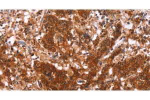 Immunohistochemistry of paraffin-embedded Human gastric cancer using HAS1 Polyclonal Antibody at dilution of 1:30 (HAS1 anticorps)