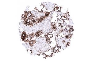 Ovary Strong predominantly membranous mesothelin staining in an endometroid ovarian cancer
