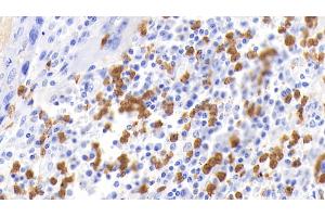 Detection of CALPRO in Human Lymphoma Tissue using Polyclonal Antibody to Calprotectin (CALPRO) (S100A8/A9 Complex (Calprotectin) anticorps  (AA 1-114))