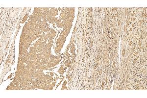 Detection of CK18 in Human Liver cancer Tissue using Monoclonal Antibody to Cytokeratin 18 (CK18)