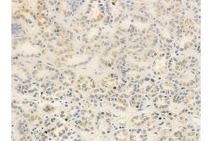 ABIN6263150 and ABIN6278791 at 1/100 staining human renal cell carcinoma by IHC-P. (MBIP anticorps  (Internal Region))