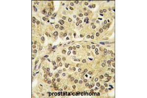 Formalin-fixed and paraffin-embedded human prostata carcinoma tissue reacted with TIEG antibody , which was peroxidase-conjugated to the secondary antibody, followed by DAB staining. (KLF10/TIEG1 anticorps  (N-Term))