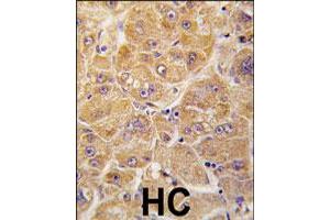 Formalin-fixed and paraffin-embedded human hepatocellular carcinoma reacted with ALDH1A1 polyclonal antibody  , which was peroxidase-conjugated to the secondary antibody, followed by DAB staining. (ALDH1A1 anticorps  (Internal Region))