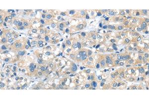 Immunohistochemistry of paraffin-embedded Human liver cancer tissue using PLXNA2 Polyclonal Antibody at dilution 1:40 (Plexin A2 anticorps)