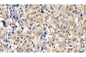 Detection of Bcl2L2 in Human Liver cancer Tissue using Polyclonal Antibody to B-Cell CLL/Lymphoma 2 Like Protein 2 (Bcl2L2) (BCL2L2 anticorps  (AA 2-193))