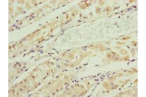Immunohistochemistry of paraffin-embedded human gastric cancer using ABIN7151148 at dilution of 1:100 (RNF135 anticorps  (AA 339-432))