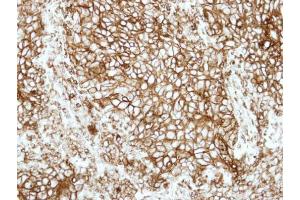 IHC-P Image Immunohistochemical analysis of paraffin-embedded human lung adenocarcinoma, using HLA-DRB1, antibody at 1:500 dilution. (HLA-DRB1 anticorps)