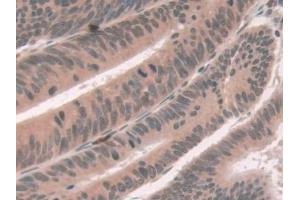 Detection of ATP7b in Human Colorectal cancer Tissue using Polyclonal Antibody to ATPase, Cu++ Transporting Beta Polypeptide (ATP7b)