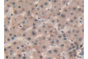 Detection of Sp100 in Human Liver cancer Tissue using Polyclonal Antibody to Sp100 Nuclear Antigen (Sp100) (SP100 anticorps  (AA 610-802))