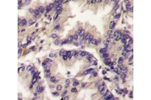 IHC analysis of FFPE human lung carcinoma tissue stained with VEGFC antibody