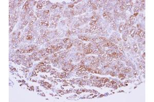 IHC-P Image Immunohistochemical analysis of paraffin-embedded human breast cancerncer, using ICAM2, antibody at 1:100 dilution. (ICAM2 anticorps)